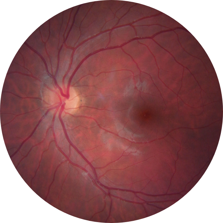 Caitlin-James-Left-Eye