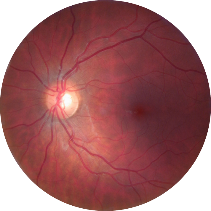 Marshall-Left-Eye_1
